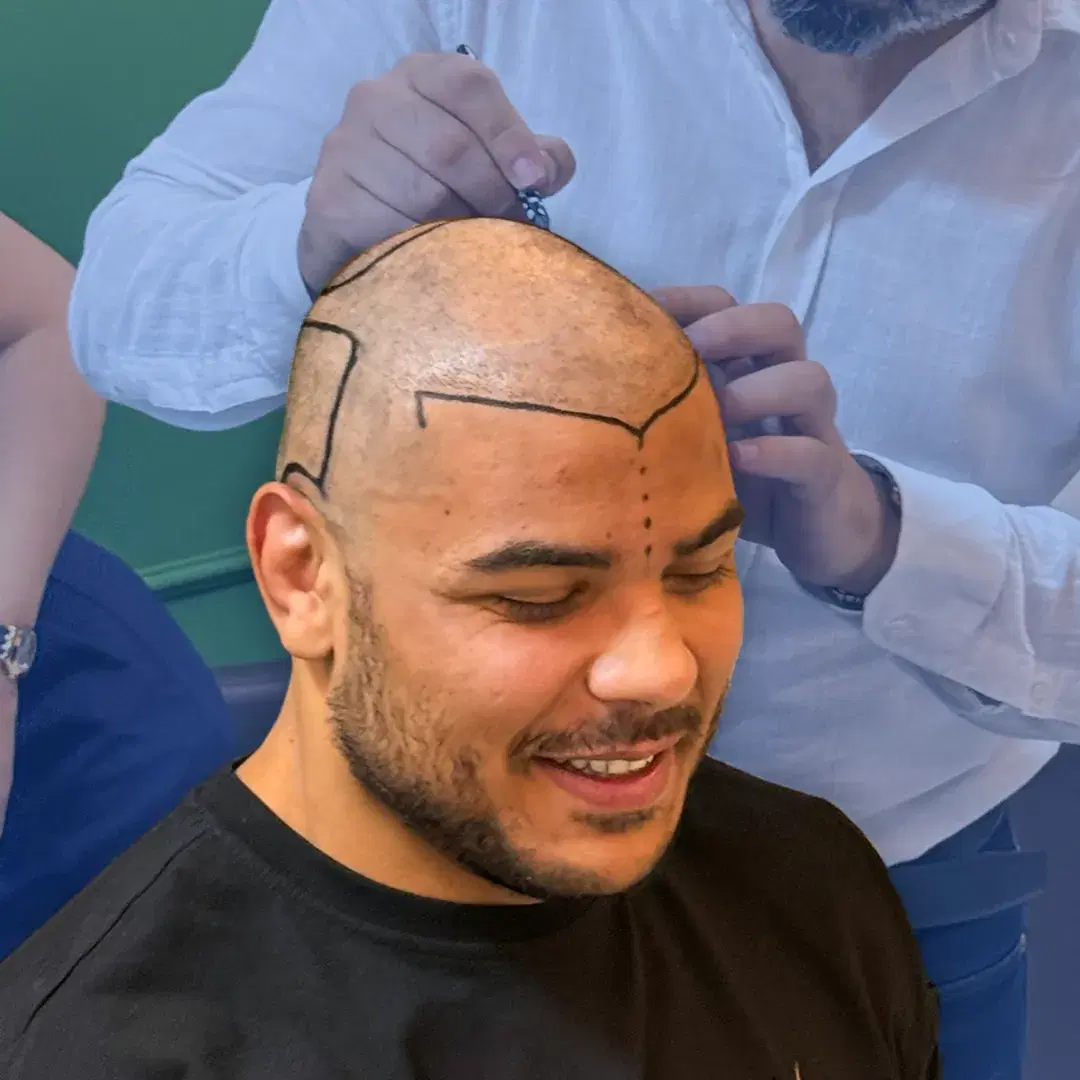 Paulo Costa's Hair Transplant Journey in Turkey: EstheticHairTurkey Experience