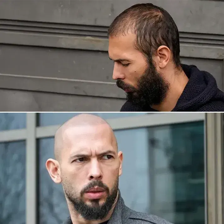Andrew Tate Hair Transplant