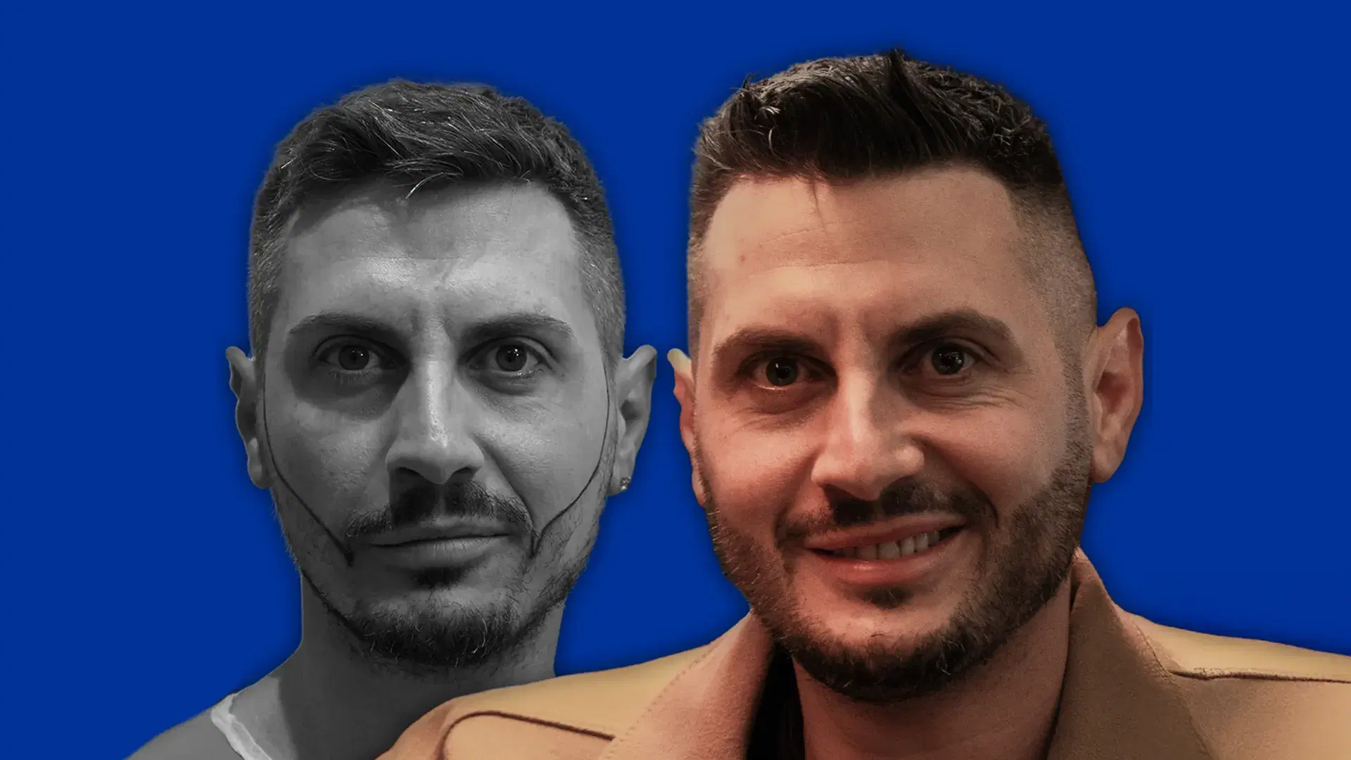 Beard Restoration Aftercare and Recovery