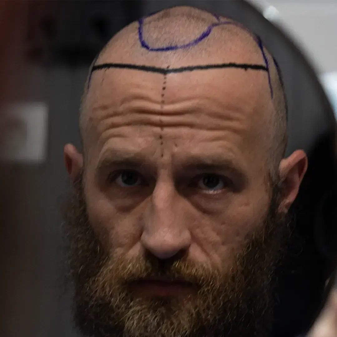 <h3><span style="color: rgb(247, 248, 248);"><strong>Consultation and Scalp Assessment</strong></span></h3><p></p>