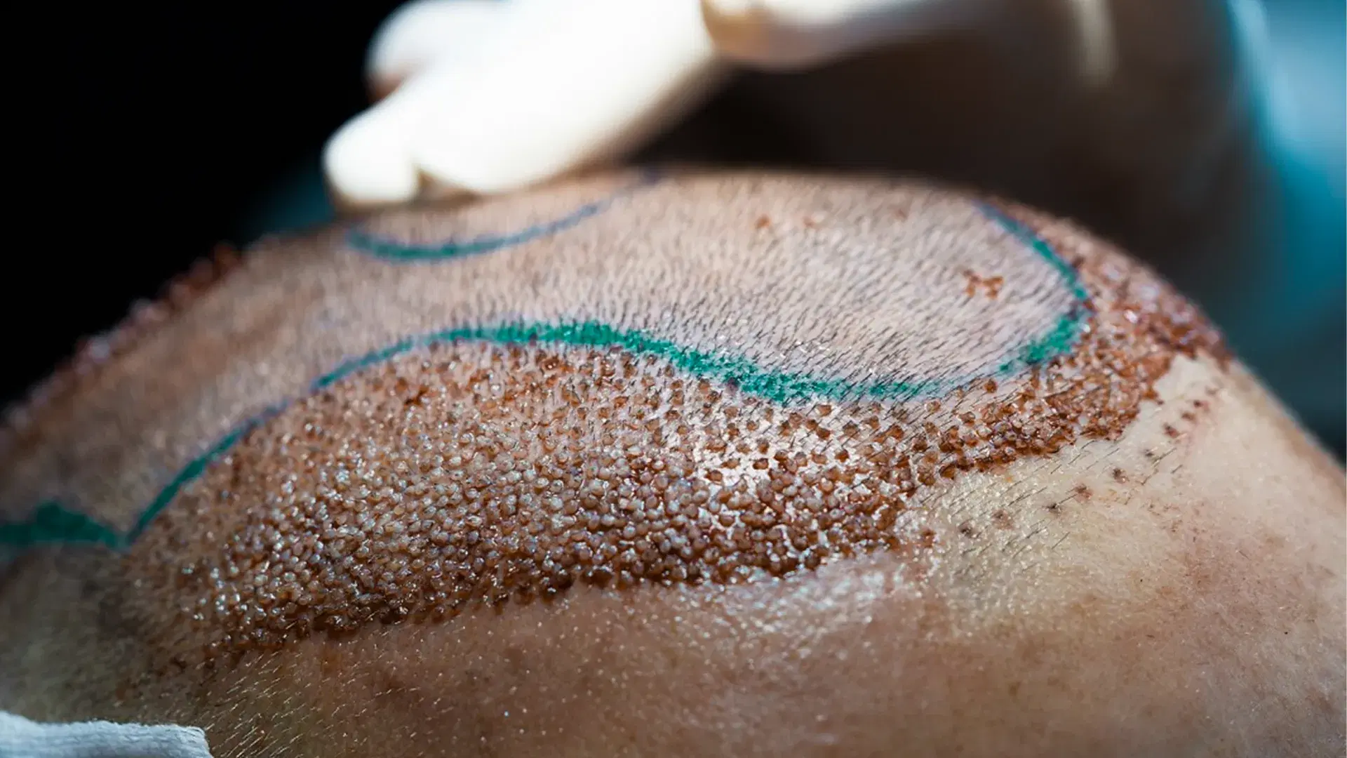 Hair Transplant Methods in Turkey