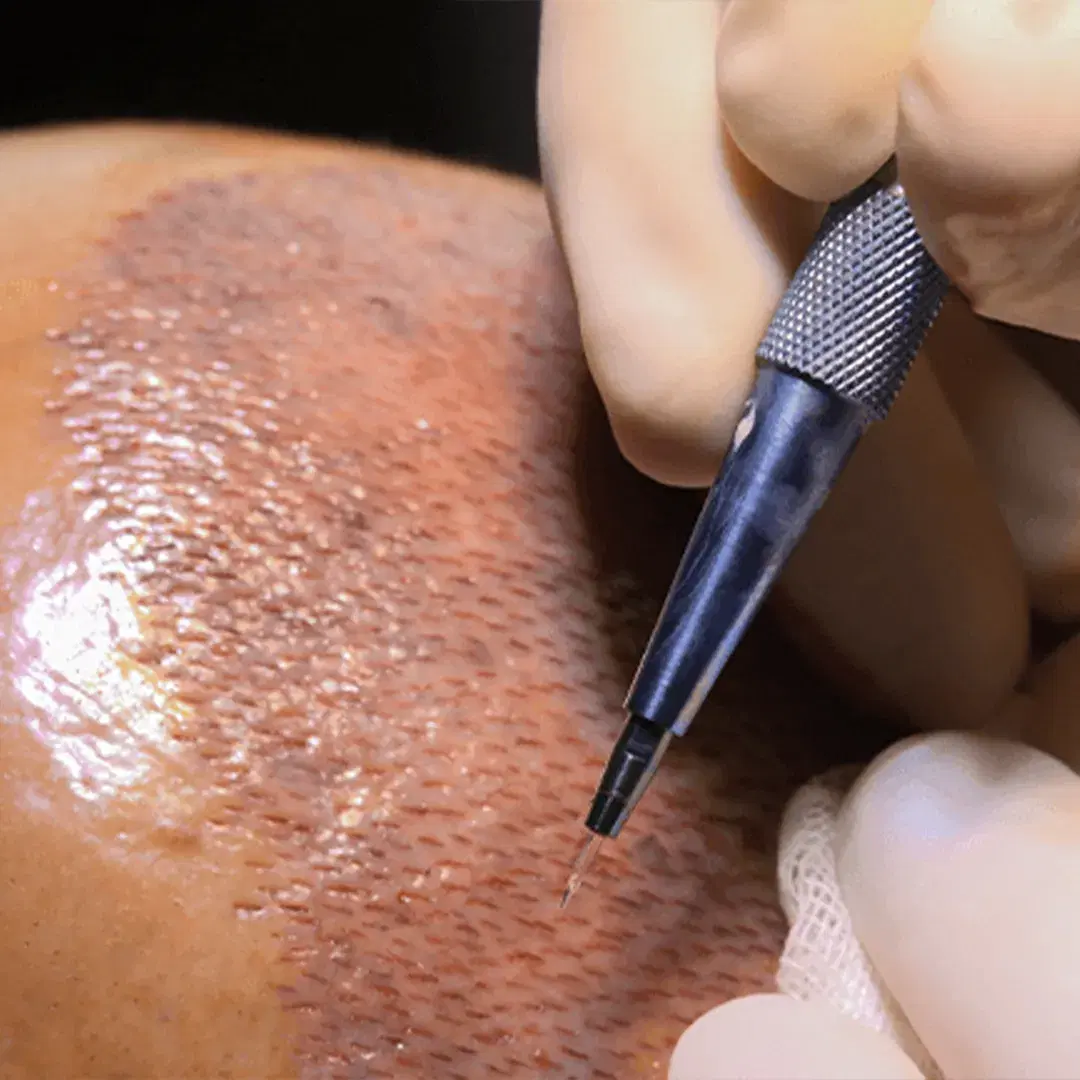 Sapphire FUE: Precise and Scar-Free Hair Restoration