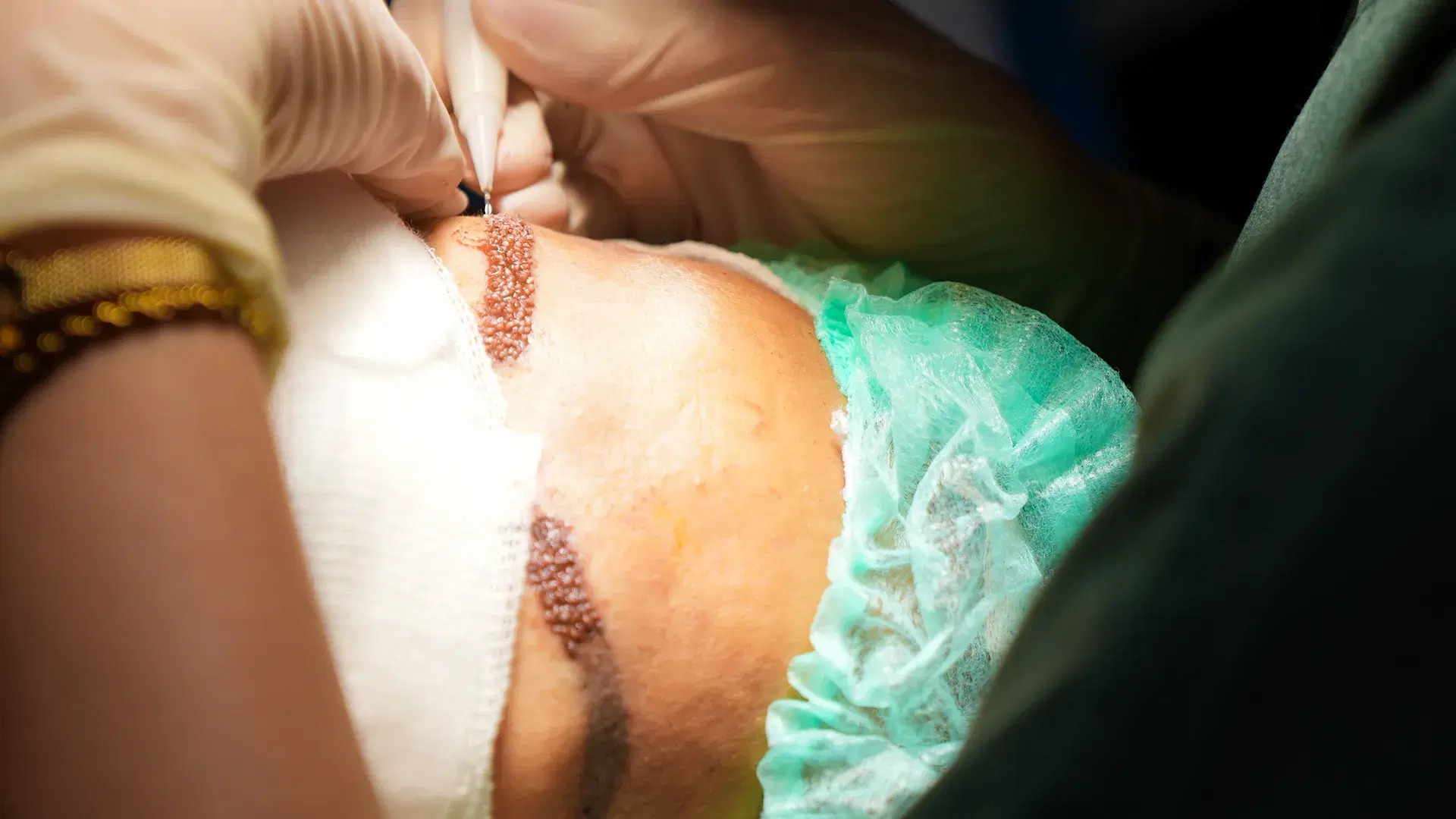 The Eyebrow Transplant Procedure at Esthetic Hair Turkey