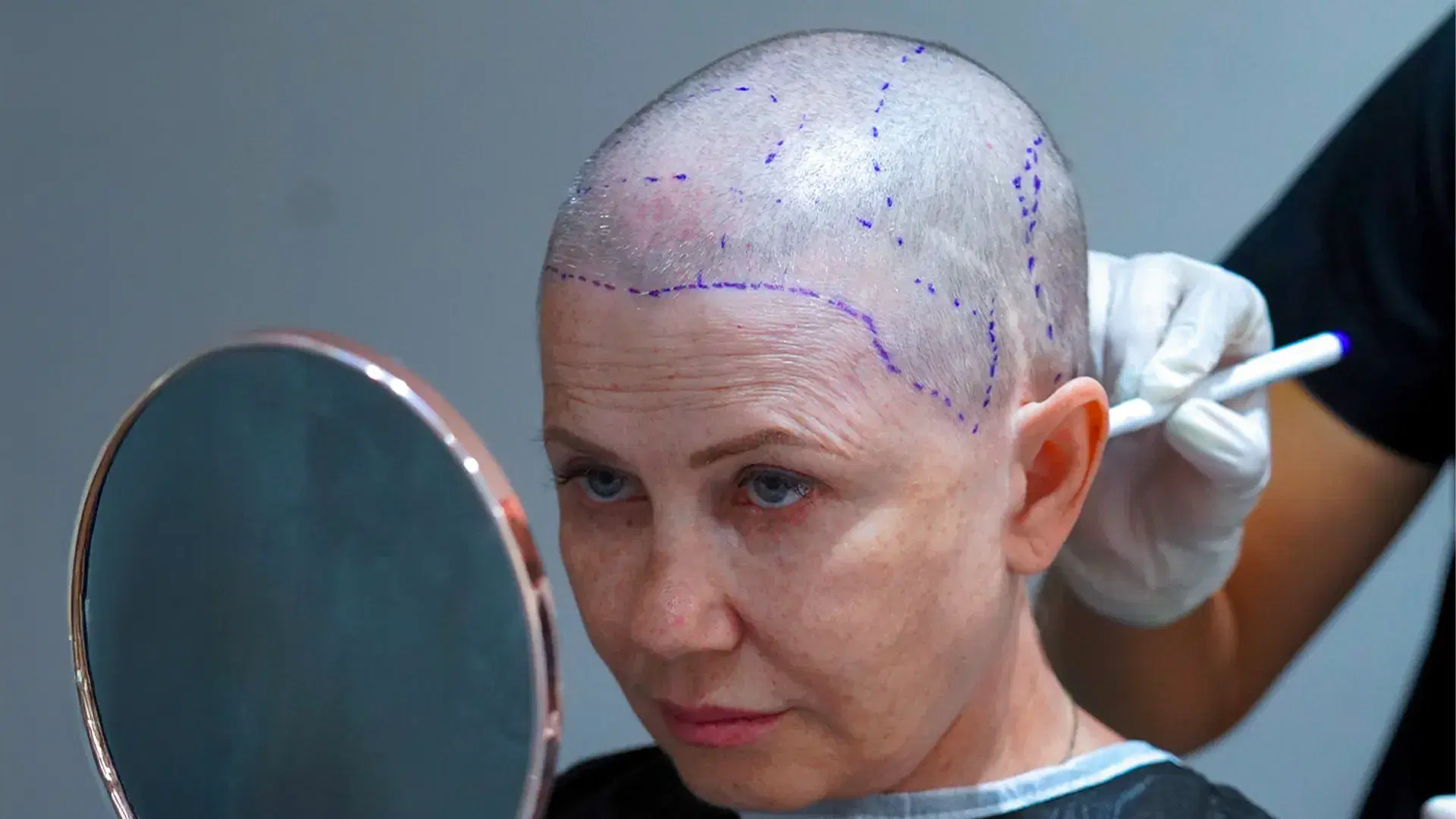 Female Hair Transplant