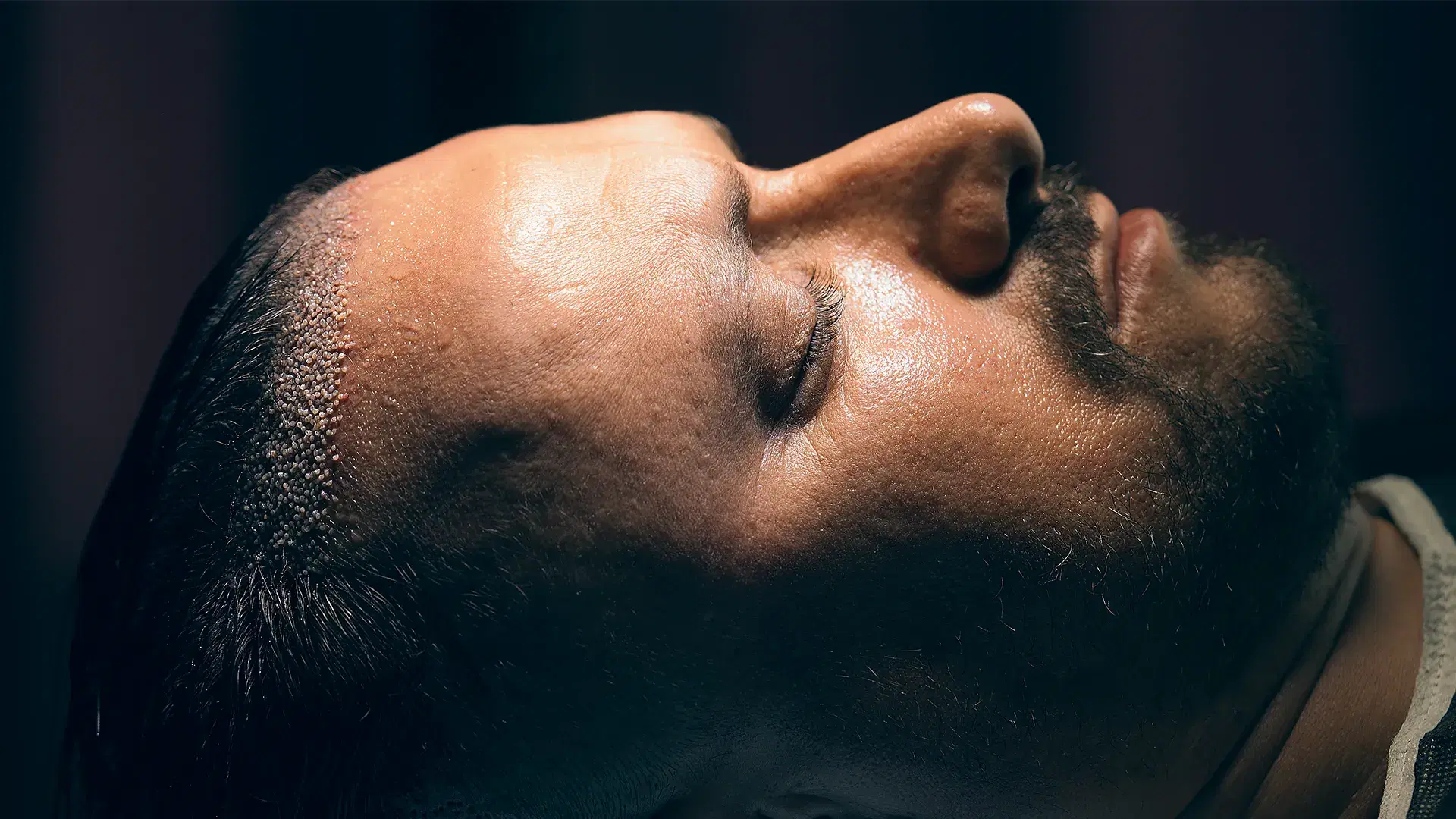 What Is an Unshaven Hair Transplant