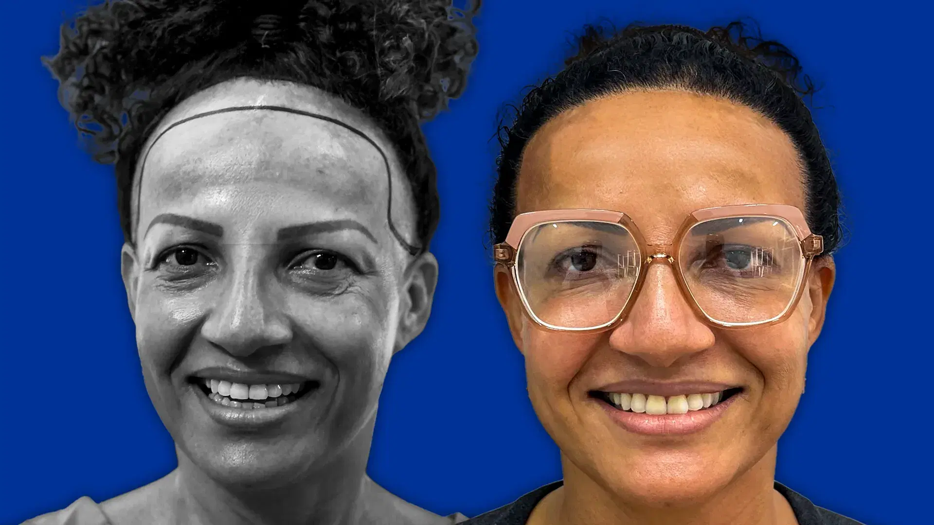 Nachsorge und Ergebnisse der Haartransplantation bei Frauen