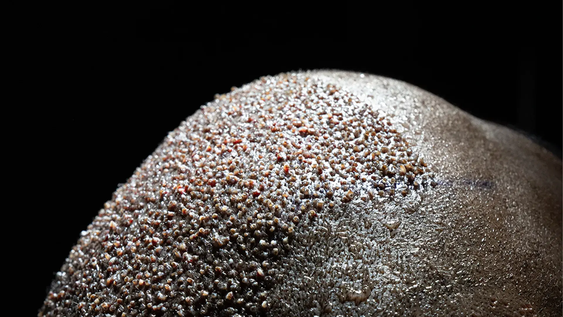 DHI für die Afro-Haartransplantation