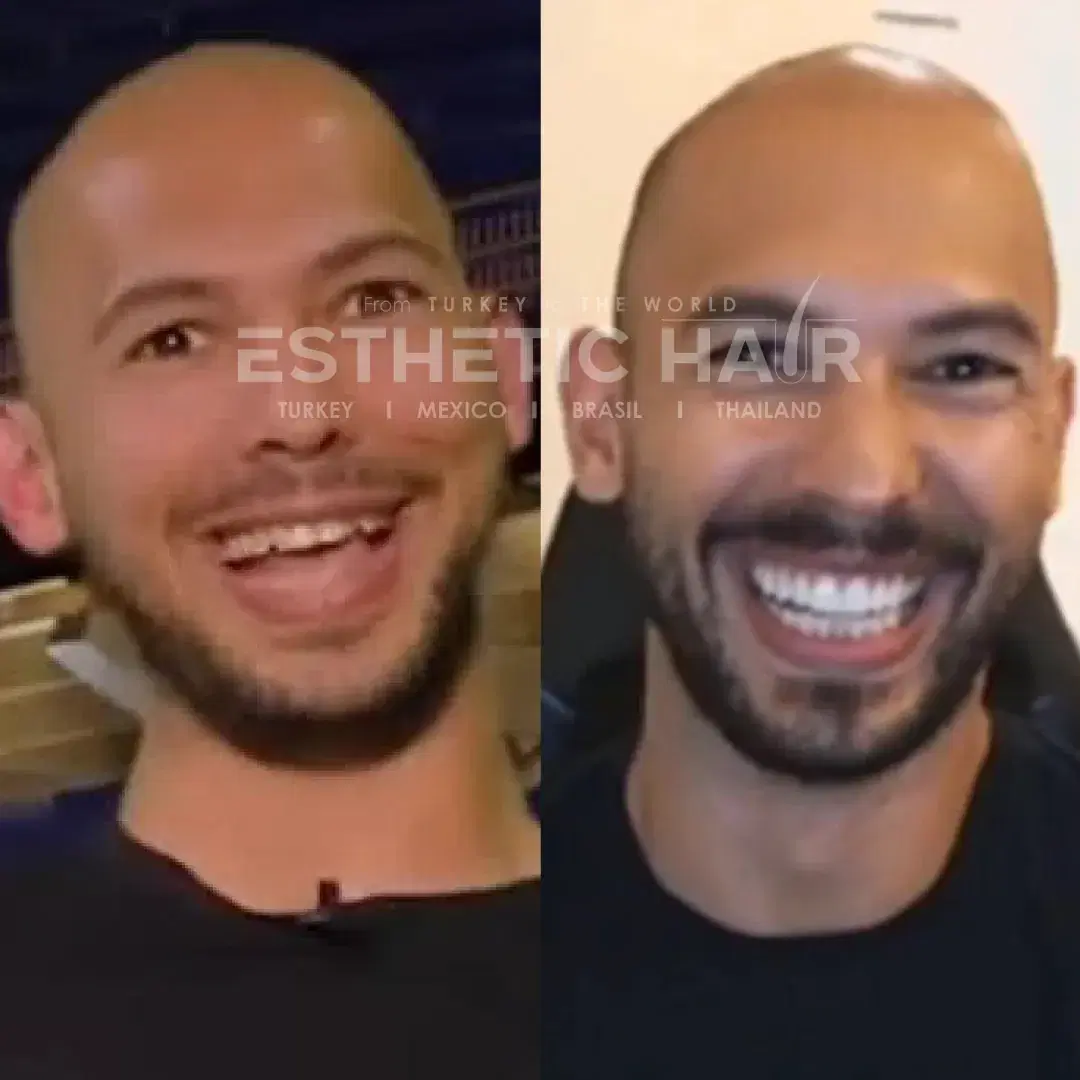 Did Andrew Tate Fix His Teeth?