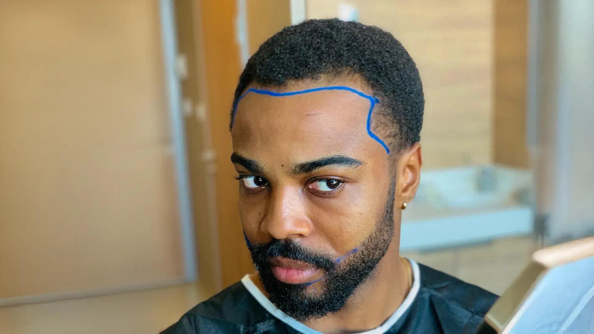 Afro-Haartransplantation verstehen