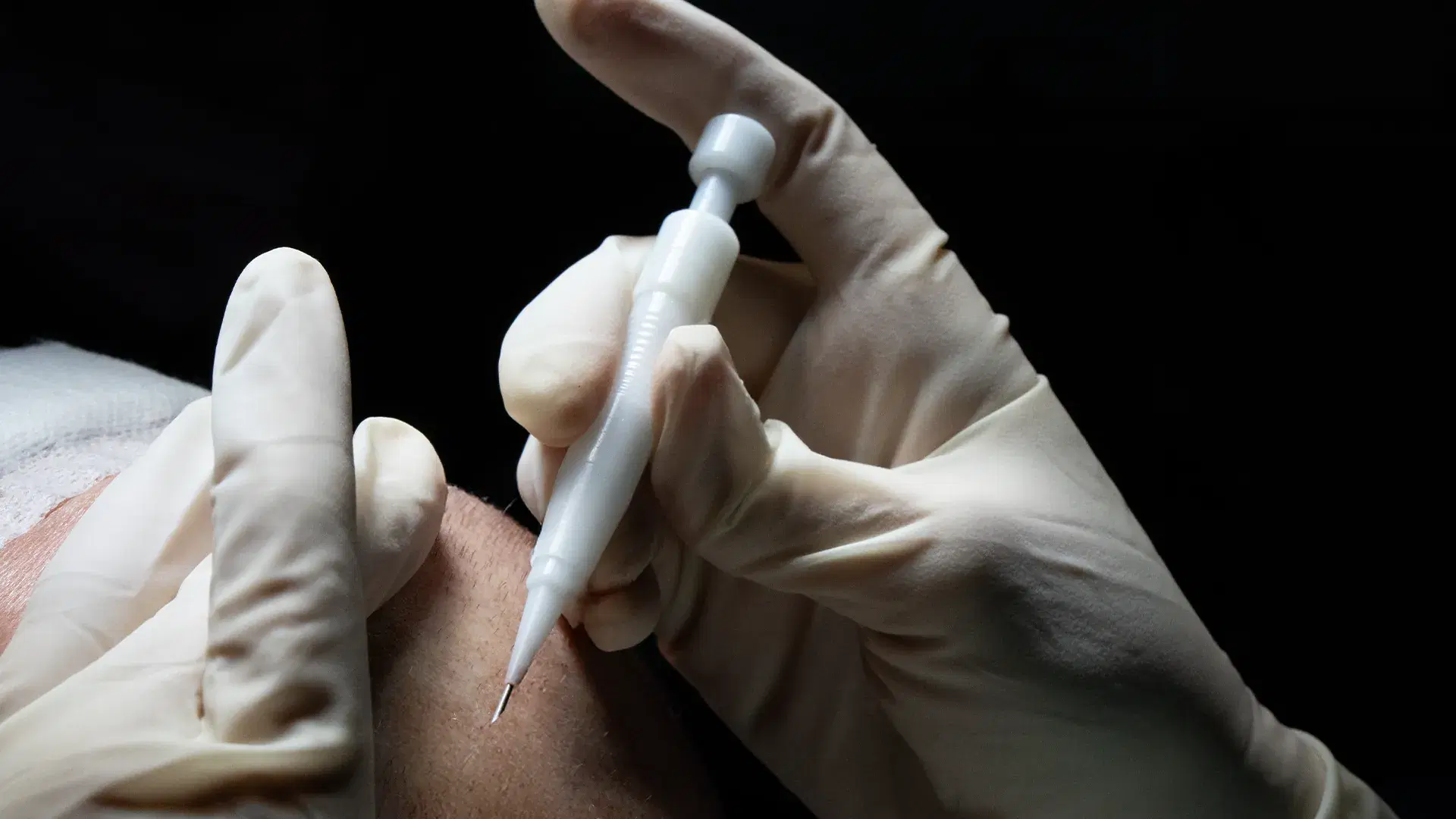 DHI Haartransplantation