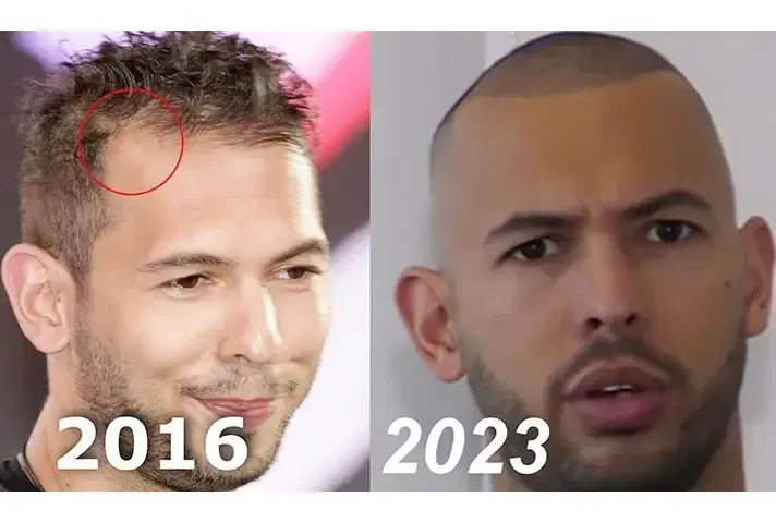 Andrew Tate Hair Transplant