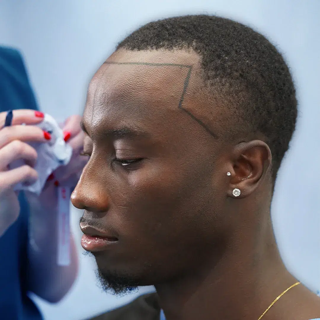 Afro Haartransplantation – Für einzigartige Haarstrukturen entwickelt