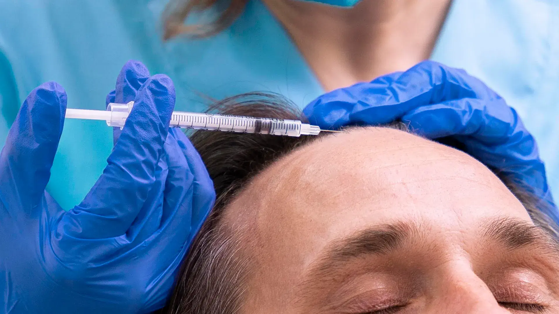 Vorteile der Mesotherapie für Haare
