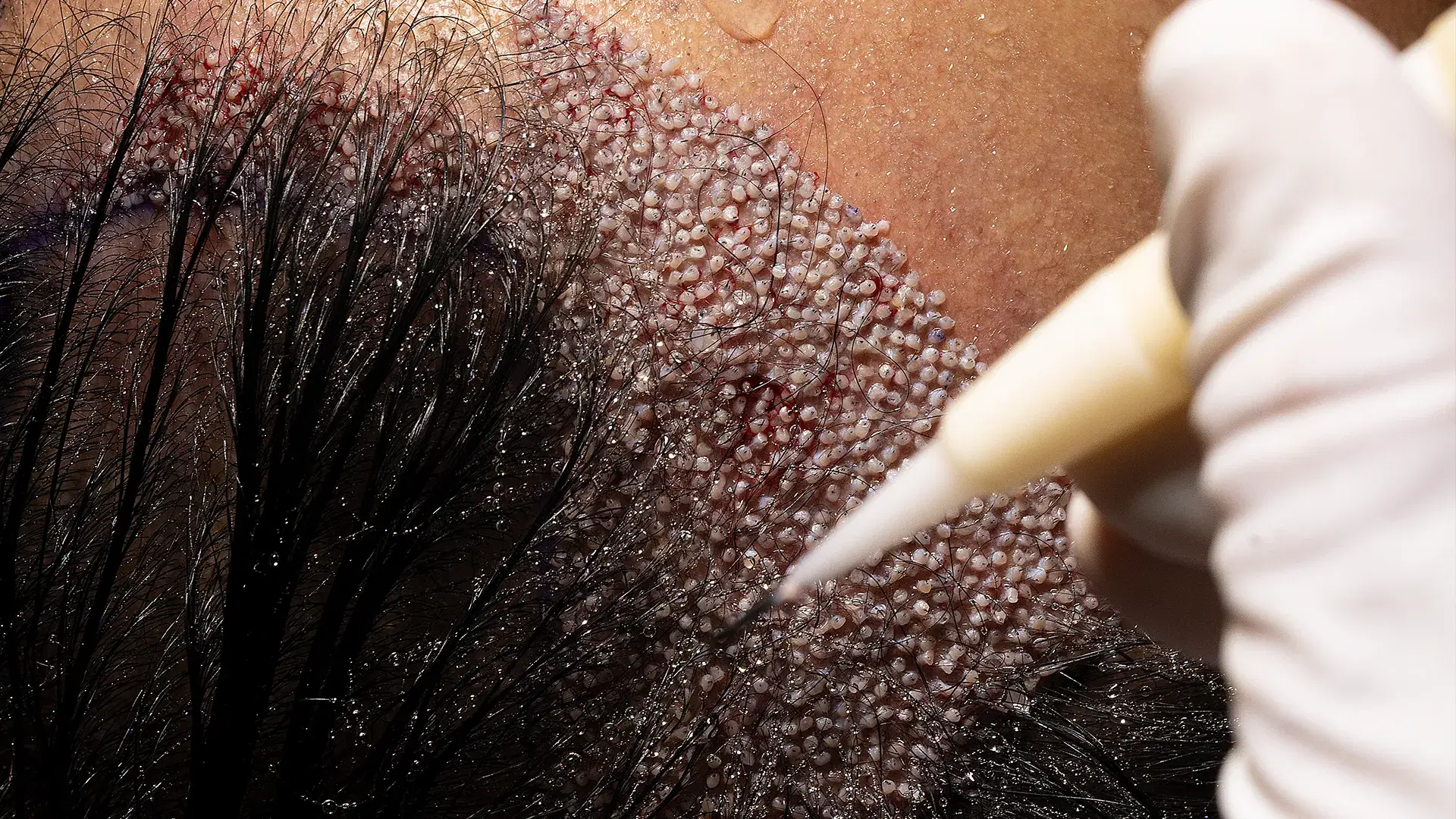 The Role of DHI in Unshaven Hair Transplants