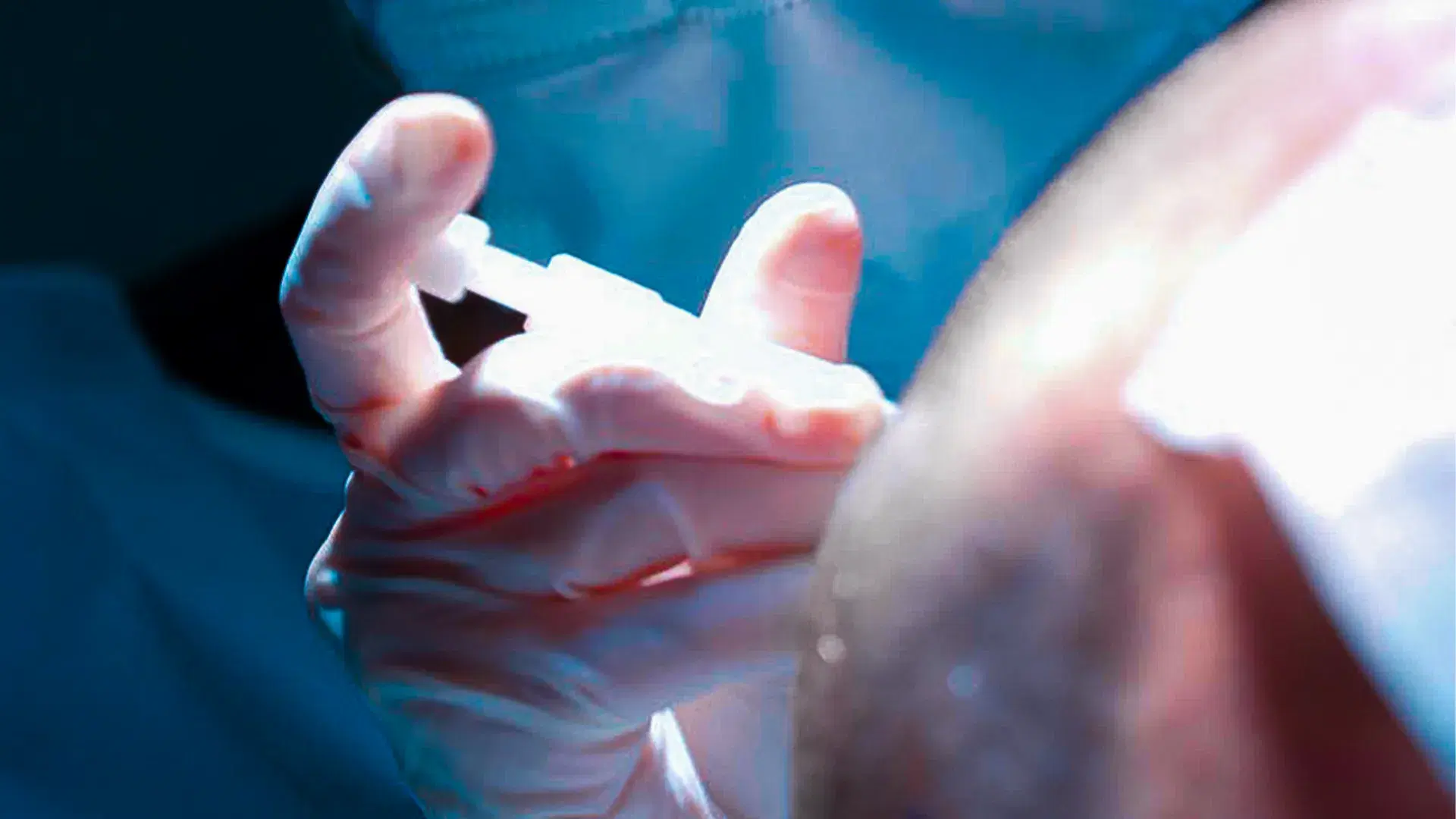 What Happens During a Hair Transplant?