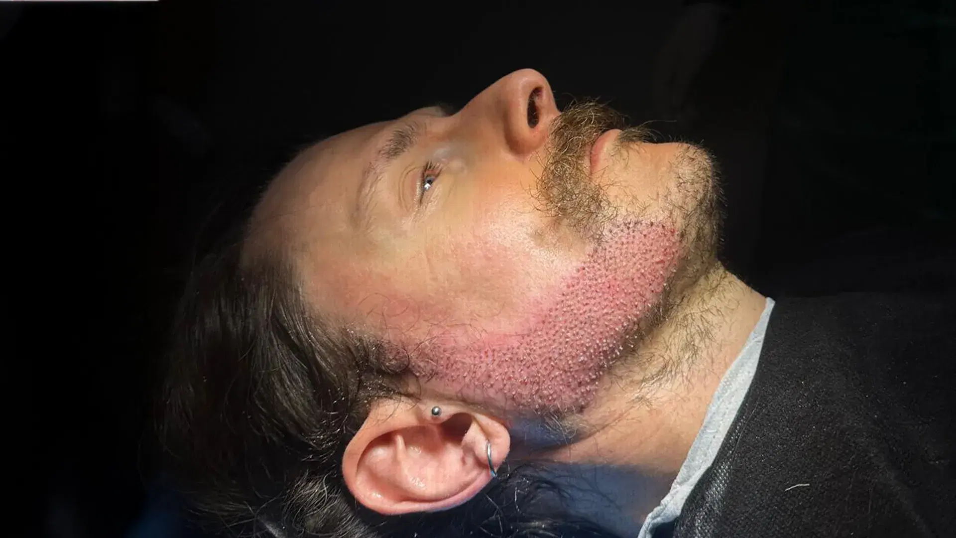 What Is a Beard Transplant?