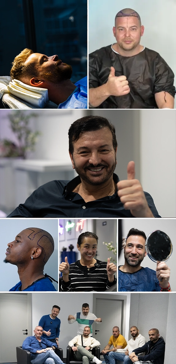 Hair Transplant Costs in Turkey